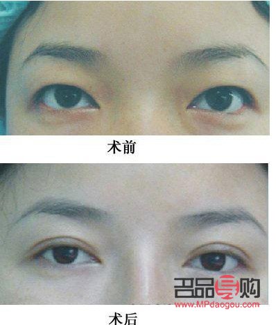 探究大小眼手術(shù)，重塑美麗雙眼