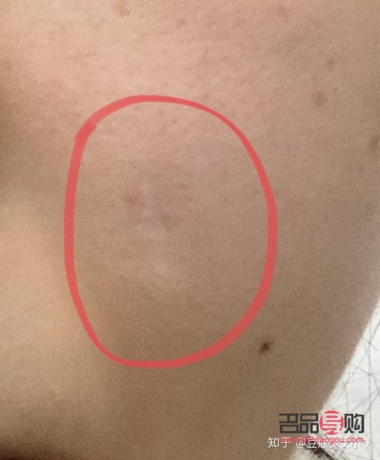 美容針容易留疤嗎