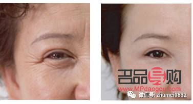 <h3>眼尾下垂圖片：解讀眼部衰老跡象及改善方法</h3>