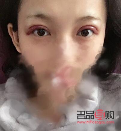 <h3>雙眼皮一個月和三個月恢復效果全解析</h3>