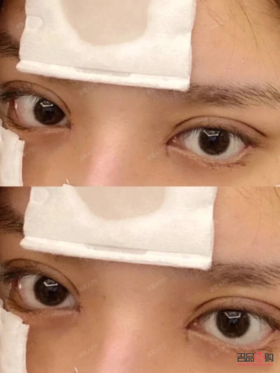 <h3>雙眼皮一個月和三個月恢復效果全解析</h3>