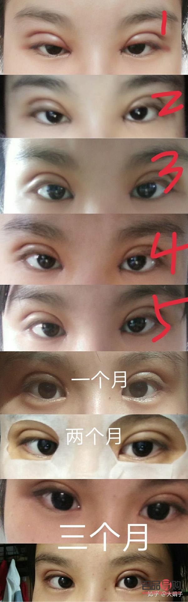 <h3>雙眼皮一個月和三個月恢復效果全解析</h3>