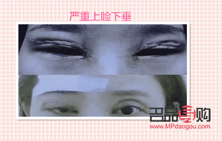 盧玲醫(yī)生雙眼皮案例分享：打造自然雙眼皮的匠心之作