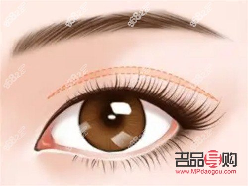 盧玲醫(yī)生雙眼皮案例分享：打造自然雙眼皮的匠心之作