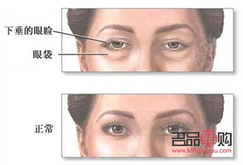 <h3>打了除皺針眼皮下垂能恢復嘛</h3>