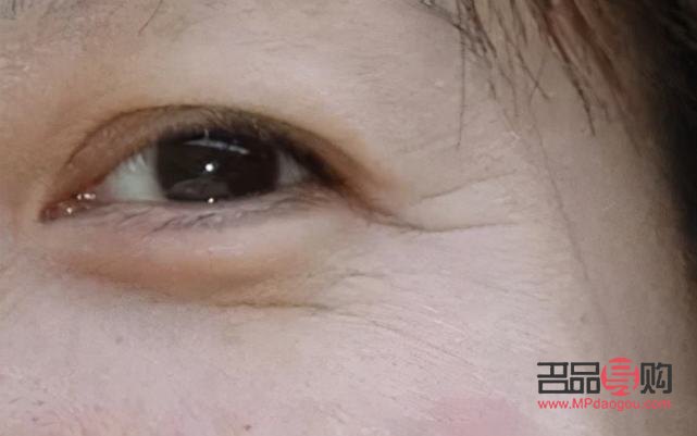 打了除皺針眼皮下垂能恢復(fù)嘛