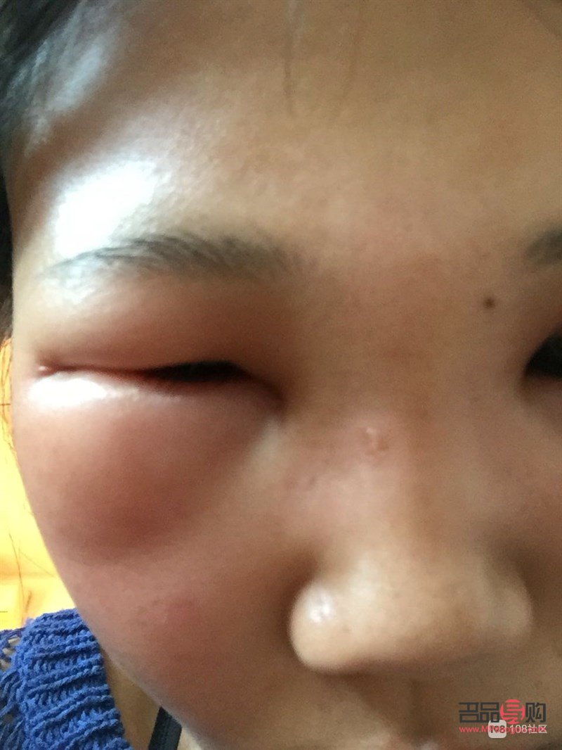 上眼皮腫眼泡怎么消除用啥中成藥(上眼皮腫眼泡怎么消除用啥中成藥好)