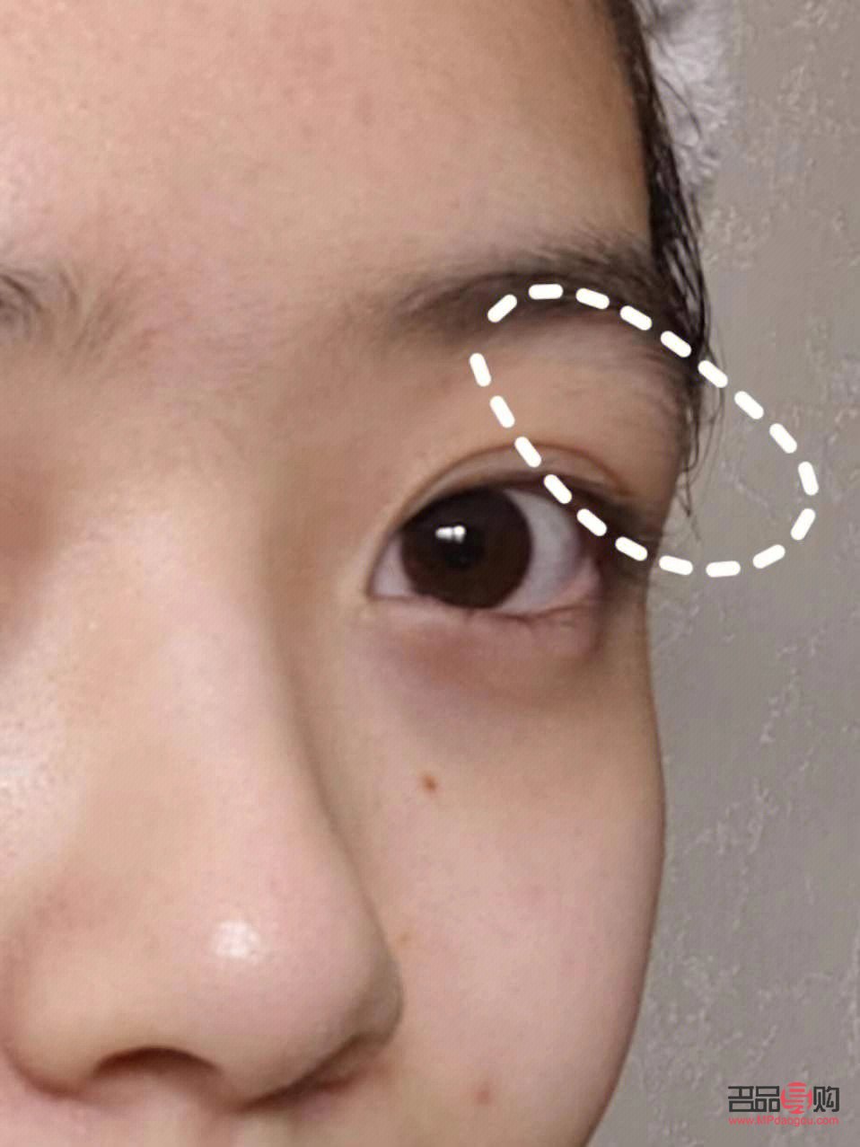 上眼皮腫眼泡怎么消除用啥中成藥(上眼皮腫眼泡怎么消除用啥中成藥好)