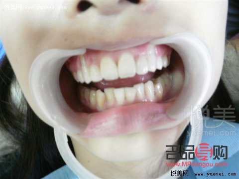 美容冠到底怎么樣——揭秘美容冠的真實(shí)效果與注意事項(xiàng)