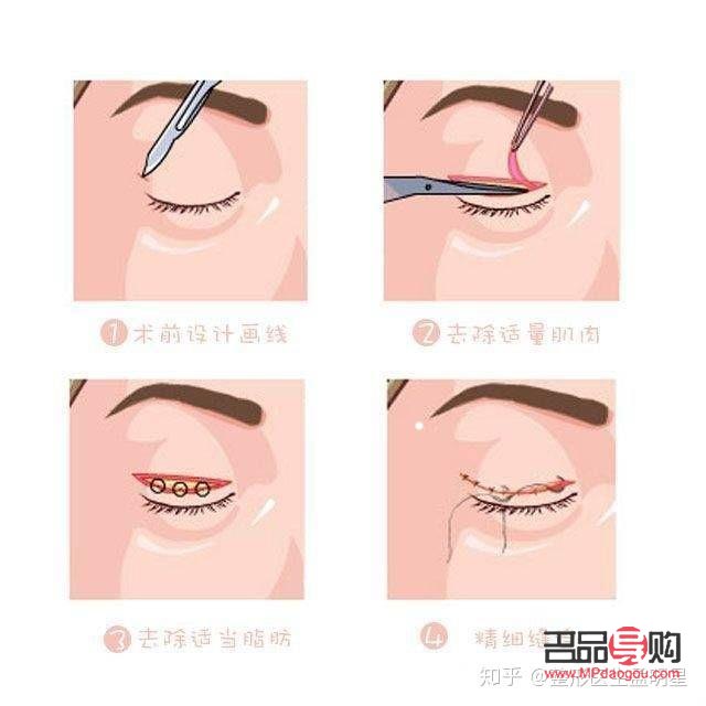 想做雙眼皮是埋線好還是割好(想做雙眼皮是埋線好還是割好呢)