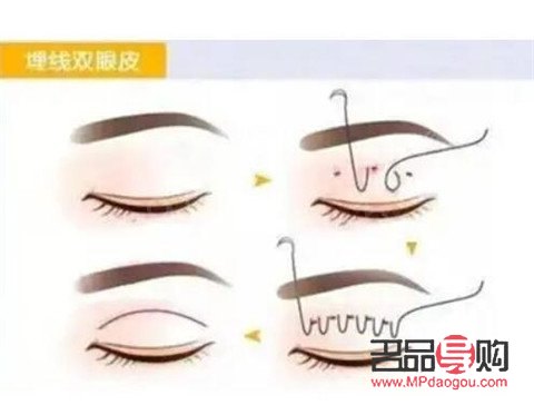 想做雙眼皮是埋線好還是割好(想做雙眼皮是埋線好還是割好呢)