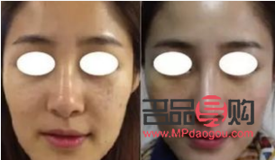 美容埋線怎么回事(美容埋線是怎么回事)