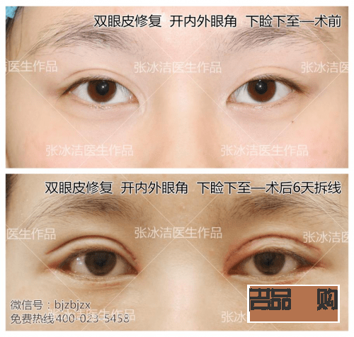 雙眼皮變成三眼皮是怎么回事(雙眼皮變成三眼皮是怎么回事玄學(xué))