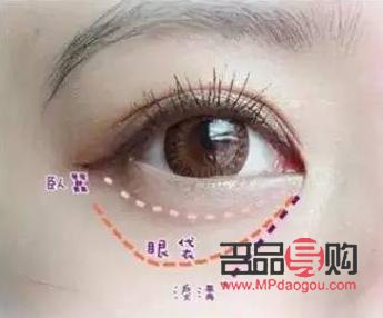眼輪匝肌肥厚型眼袋怎么去除(眼輪匝肌肥厚型眼袋怎么去除最有效)
