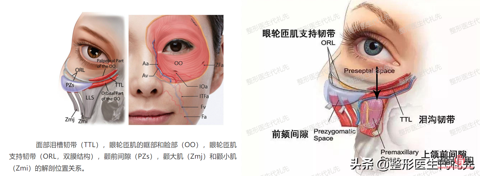 眼輪匝肌肥厚型眼袋怎么去除(眼輪匝肌肥厚型眼袋怎么去除最有效)
