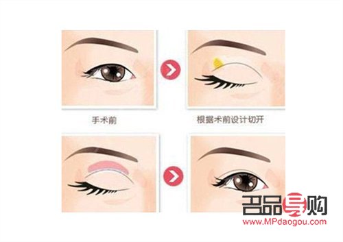 <h3>眼角下垂 怎么提升</h3>