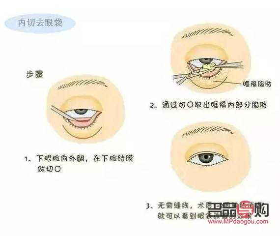 <h3>眼角下垂 怎么提升</h3>