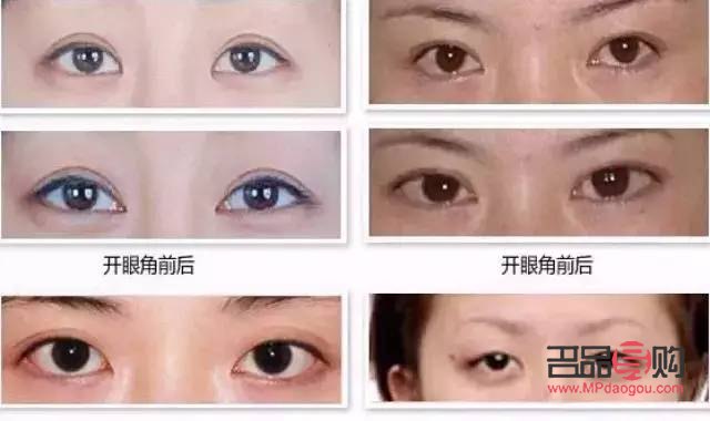 開眼角哪家美名(哪家做開眼角好啊)