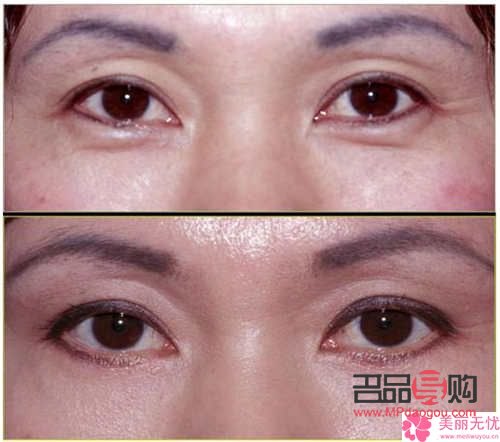 內(nèi)切眼袋可以維持幾年(內(nèi)切眼袋可以維持幾年壽命)