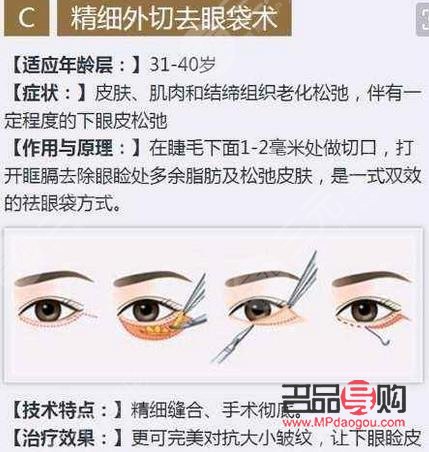 內(nèi)切眼袋可以維持幾年(內(nèi)切眼袋可以維持幾年壽命)