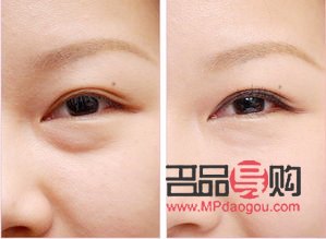 內(nèi)切眼袋可以維持幾年(內(nèi)切眼袋可以維持幾年壽命)