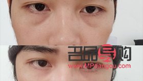 眼窩凹陷自體脂肪填充有風險嗎(眼窩凹陷自體脂肪填充有風險嗎視頻)