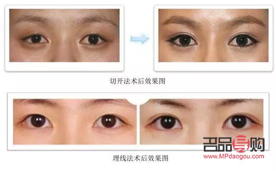 6D翹睫雙眼皮與埋線技術(shù)解析