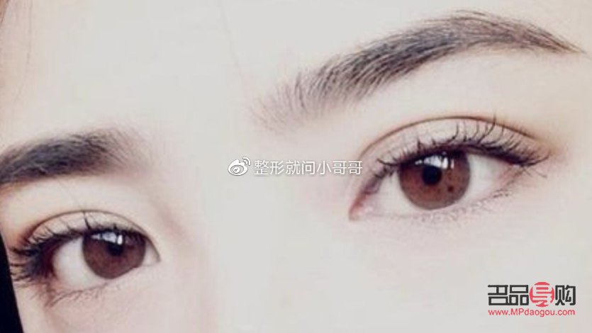 <h3>肉條雙眼皮是什么樣子？詳解雙眼皮類(lèi)型與特征</h3>