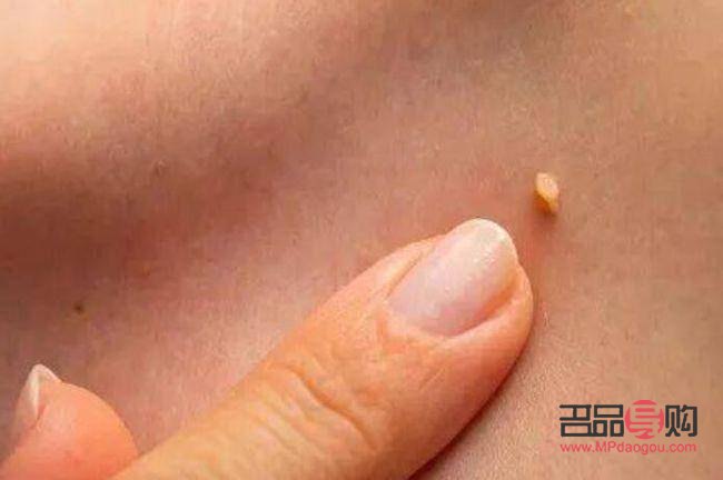 長疣怎么身體護(hù)理(長疣怎么身體護(hù)理最好)