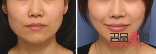 <h3>高低眉大小眼歪臉矯正方法大揭秘</h3>