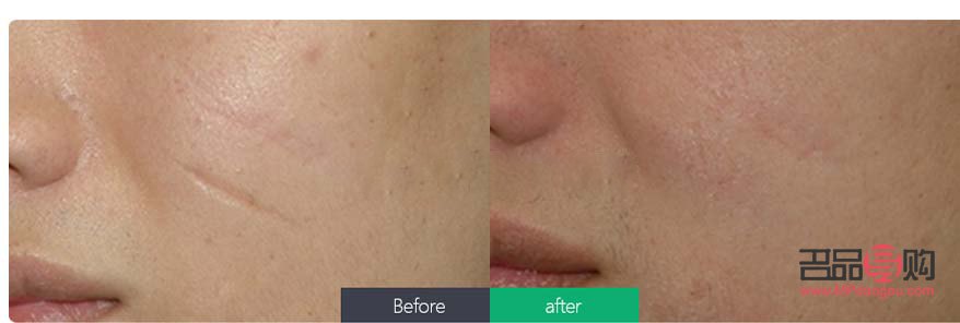 美容院怎么去疤痕(美容院可以去疤痕嗎)