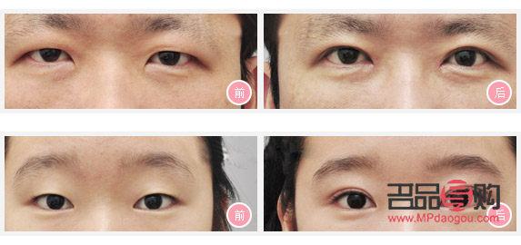 眼皮松弛適合做哪種雙眼皮