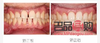 門牙美容冠是什么(門牙美容冠是什么材質(zhì))