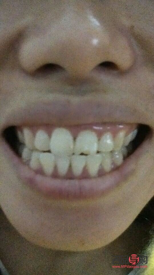 門牙美容冠是什么(門牙美容冠是什么材質)