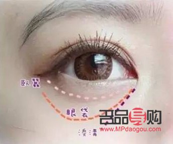 黑眼圈淚溝眼袋的區(qū)別圖片(黑眼圈眼袋淚溝圖片區(qū)分)