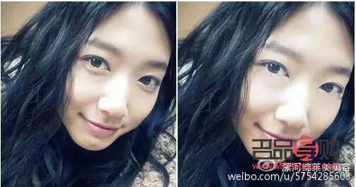 黑眼圈淚溝眼袋的區(qū)別圖片(黑眼圈眼袋淚溝圖片區(qū)分)