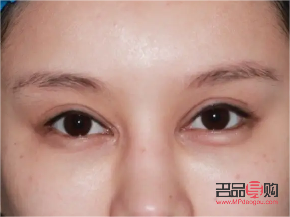 割雙眼皮對(duì)眼睛有什么影響(割雙眼皮對(duì)眼睛有什么影響嗎)