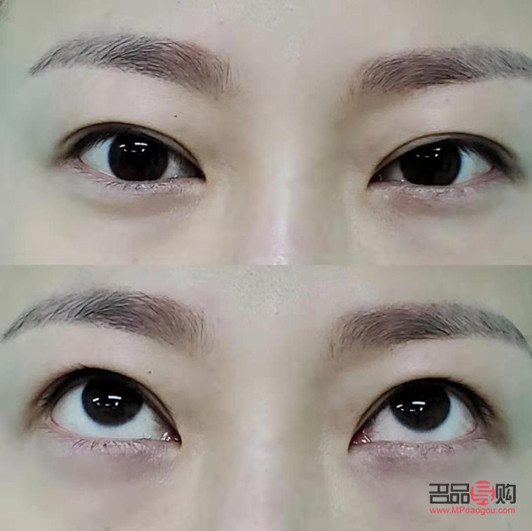 割雙眼皮對(duì)眼睛有什么影響(割雙眼皮對(duì)眼睛有什么影響嗎)
