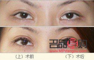 割雙眼皮對(duì)眼睛有什么影響(割雙眼皮對(duì)眼睛有什么影響嗎)