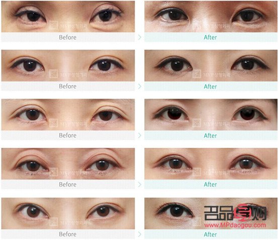 改變眼型：探索眼部整形的奧秘與美學(xué)