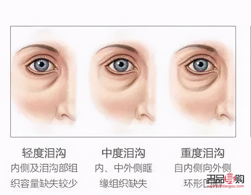 <h3>眼袋加淚溝綜合手術(shù)多少錢？全面解析手術(shù)費用及影響因素</h3>
