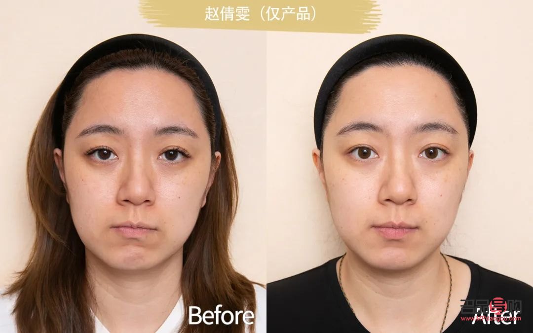 <h3>眼袋加淚溝綜合手術(shù)多少錢？全面解析手術(shù)費用及影響因素</h3>