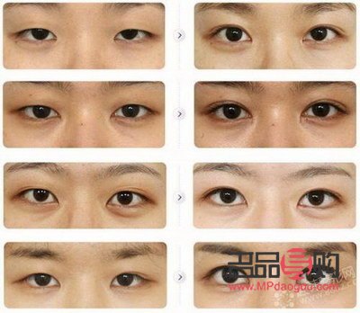 雙眼皮改單眼皮成功了(雙眼皮改單眼皮成功了會怎么樣)