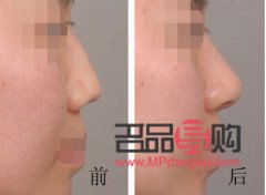 手術(shù)美容線多少錢(手術(shù)美容線多少錢一根)