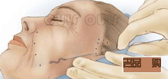 手術(shù)美容線多少錢(手術(shù)美容線多少錢一根)