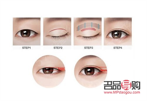 <h3>什么雙眼皮最便宜</h3>