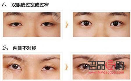 <h3>什么雙眼皮最便宜</h3>