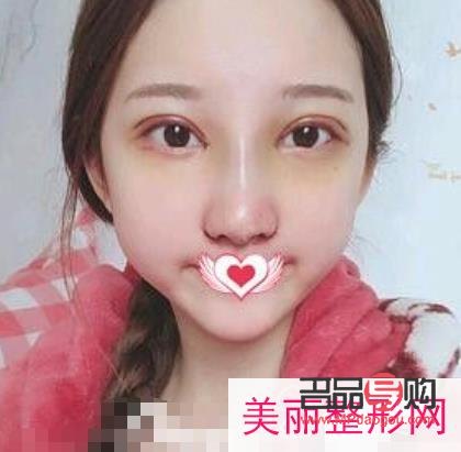 <h3>什么雙眼皮最便宜</h3>