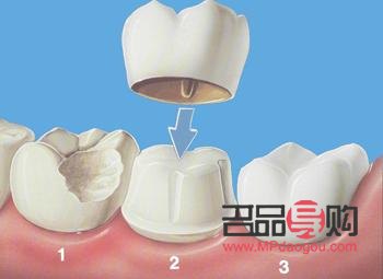 美容牙冠好嗎(美容牙冠好嗎安全嗎)