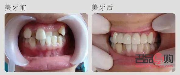 美容牙冠好嗎(美容牙冠好嗎安全嗎)